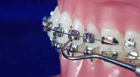 brackets metalicos sin gomas|brackets autoligables.